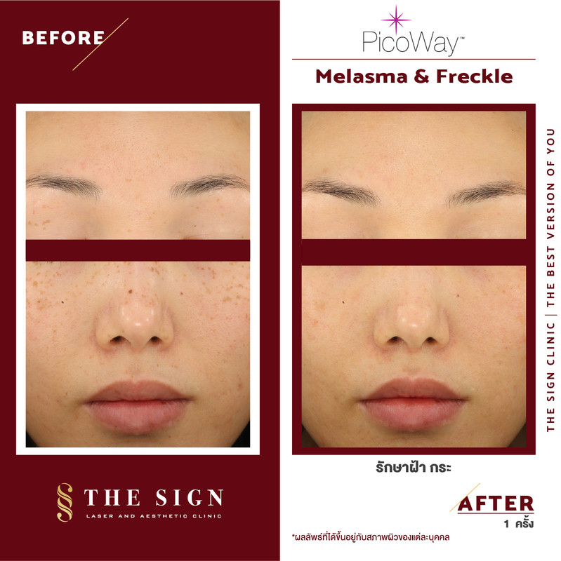 รีวิว PicoWay Melasma รักษาฝ้า กระ ที่เดอะไซน์ คลินิก (The Sign Clinic) 6 content the sign review pico way melasma 2