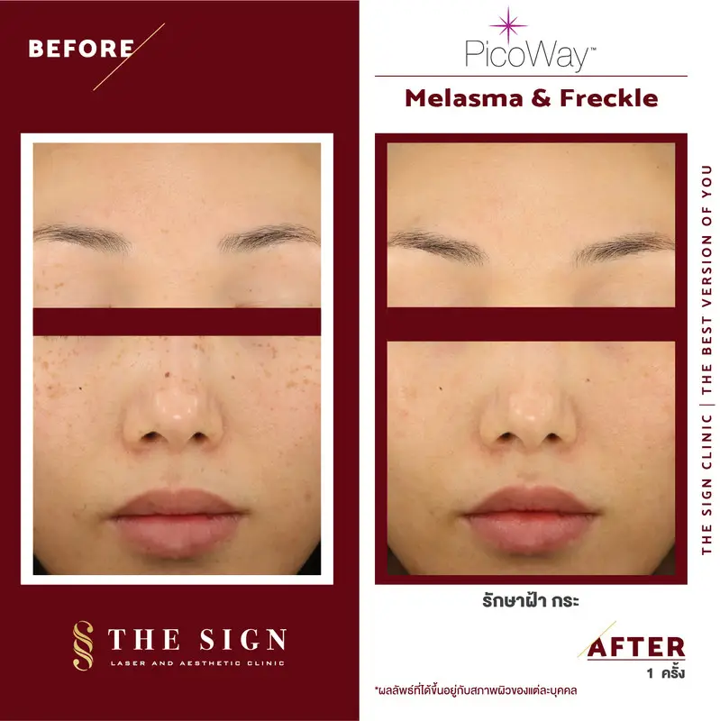 รีวิว PicoWay Melasma รักษาฝ้า กระ ที่เดอะไซน์ คลินิก (The Sign Clinic) 6 content the sign review pico way melasma 2