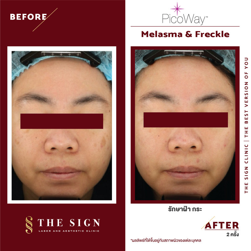 รีวิว PicoWay Melasma รักษาฝ้า กระ ที่เดอะไซน์ คลินิก (The Sign Clinic) 4 content the sign review pico way melasma 3
