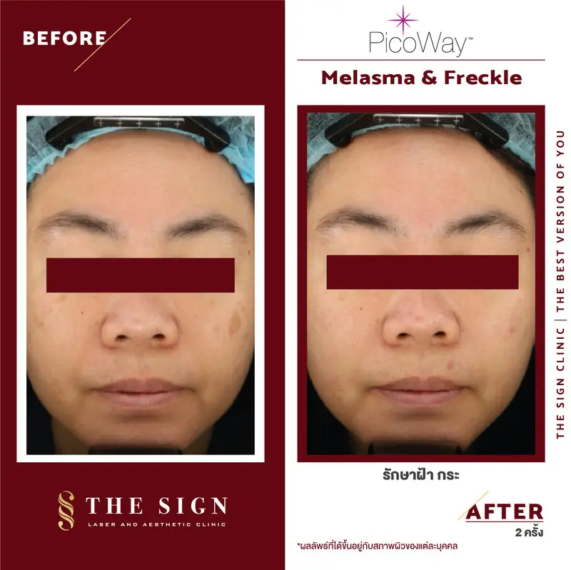 รีวิว PicoWay Melasma รักษาฝ้า กระ ที่เดอะไซน์ คลินิก (The Sign Clinic) 4 content the sign review pico way melasma 3