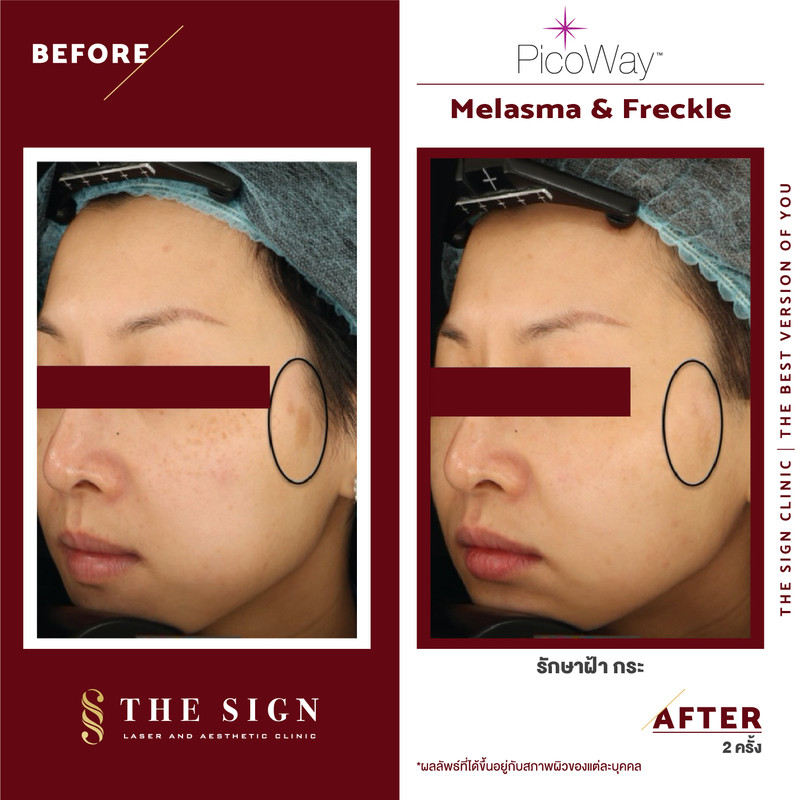 รีวิว PicoWay Melasma รักษาฝ้า กระ ที่เดอะไซน์ คลินิก (The Sign Clinic) 7 content the sign review pico way melasma 4