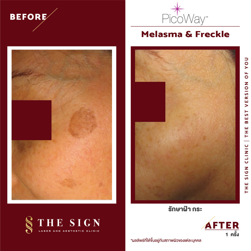รีวิว PicoWay Melasma รักษาฝ้า กระ ที่เดอะไซน์ คลินิก (The Sign Clinic) 5 content the sign review pico way melasma 5