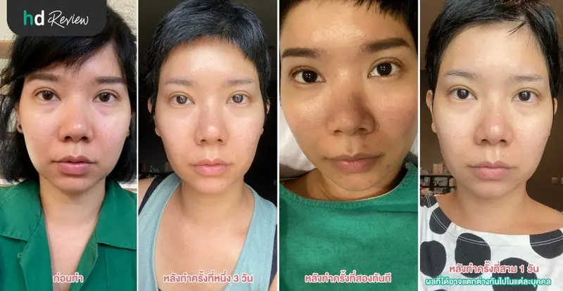 รีวิว ฝังเข็มกระตุ้นไฟฟ้า ลดริ้วรอยร่องแก้ม ที่ สวนกวางตุ้งคลินิก