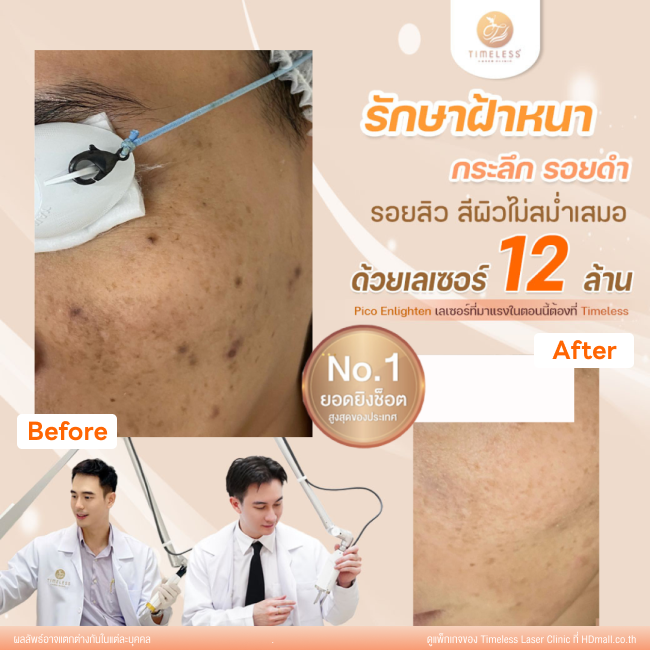 ผลลัพธ์หลังใช้บริการโปรแกรม Pico Enlighten ที่ Timeless Laser Clinic รูป 10