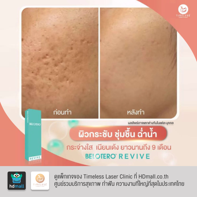 รีวิวฉีดฟิลเลอร์หน้าใส โปรแกรมฉีดฟิลเลอร์ Belotero Revive ที่ Timeless Laser Clinic รูป 9