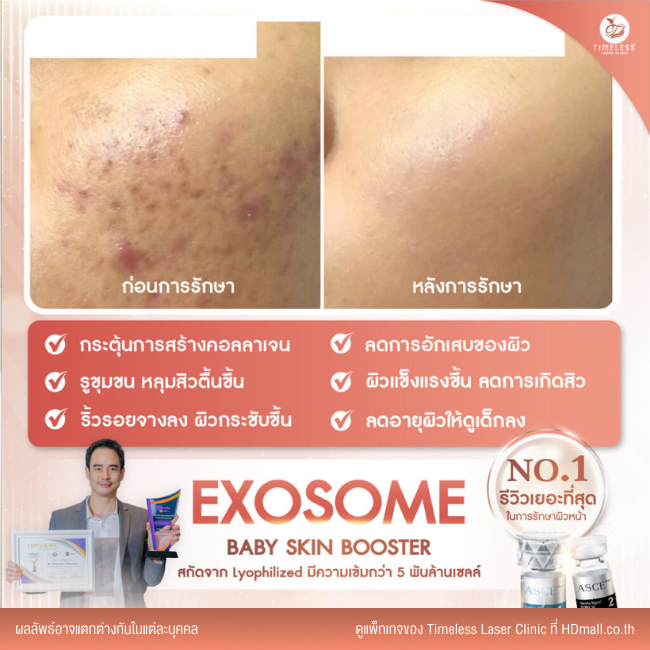 ผลลัพธ์หลังใช้บริการโปรแกรม Exosome ที่ Timeless Laser Clinic รูป 7