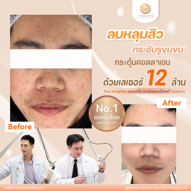 ผลลัพธ์หลังเลเซอร์หลุมสิว โปรแกรม Pico Enlighten ที่ Timeless Laser Clinic รูป 10
