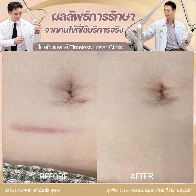 ผลลัพธ์หลังเลเซอร์ลดรอยแผลเป็น โปรแกรม Pico Enlighten ที่ Timeless Laser Clinic รูป 10