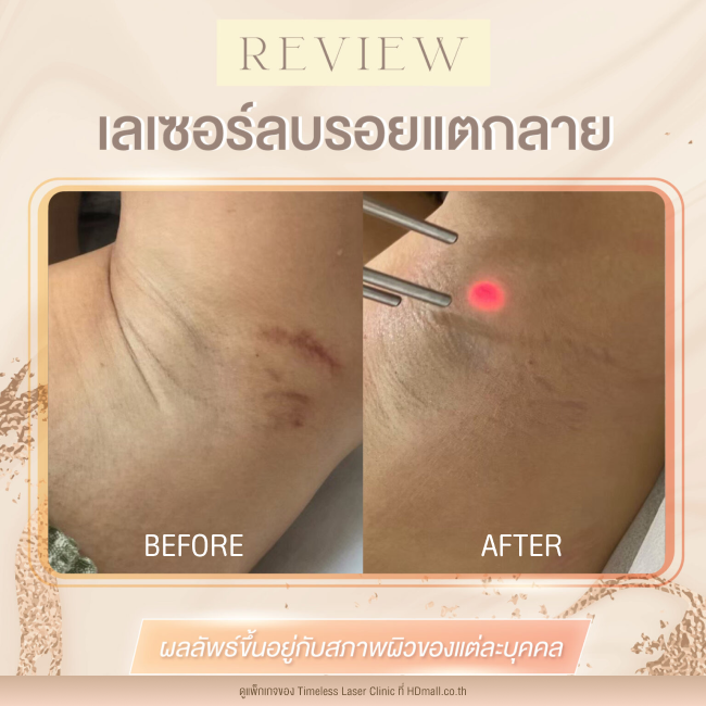 ผลลัพธ์หลังเลเซอร์ลดรอยแตกลาย โปรแกรม Pico Enlighten ที่ Timeless Laser Clinic รูป10