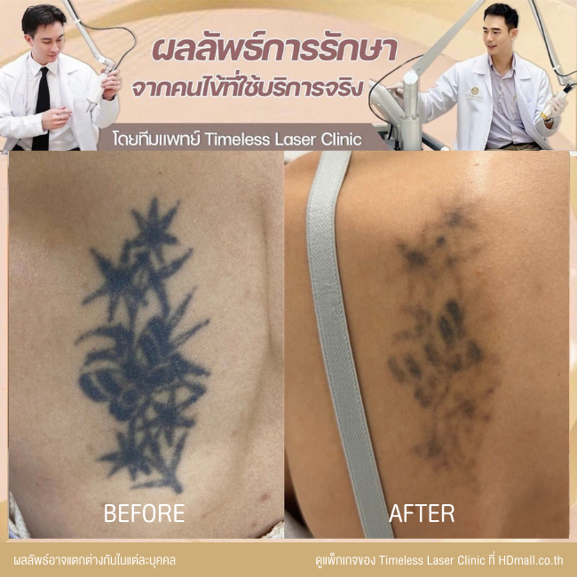 ผลลัพธ์หลังลบรอยสัก ลบรอยสักคิ้ว โปรแกรม Pico Enlighten ที่ Timeless Laser Clinic รูป 10