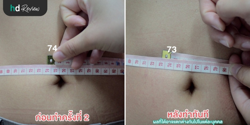 รีวิวสลายไขมันด้วยความเย็น Cool Slim ที่ Punnisa Clinic
