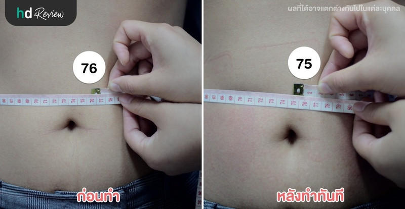 รีวิวสลายไขมันด้วยความเย็น Cool Slim ที่ Punnisa Clinic