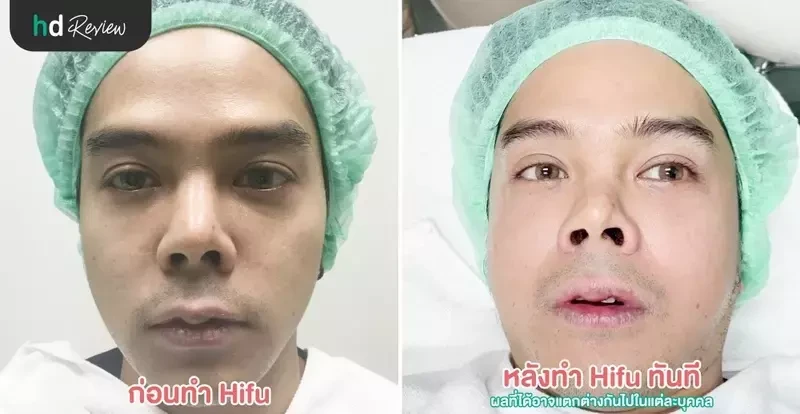 ภาพ Before After การทำ Hifu ที่ LV Aesthetic By Dr.Lucy