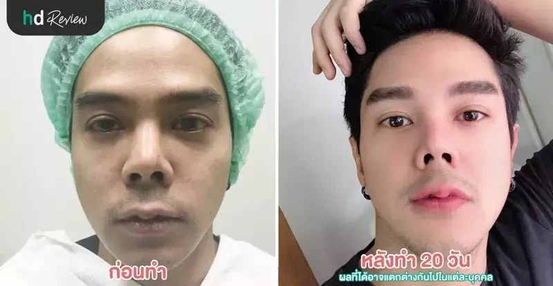 ภาพ Before After การทำ Hifu และฉีดโบฯ ลดริ้วรอย ที่ LV Aesthetic By Dr.Lucy