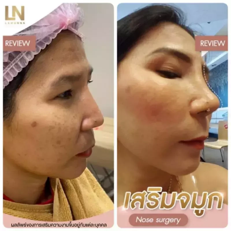 ภาพรีวิวเสริมจมูก ด้วยซิลิโคนแมนทิส ที่ Clinic Lamunna