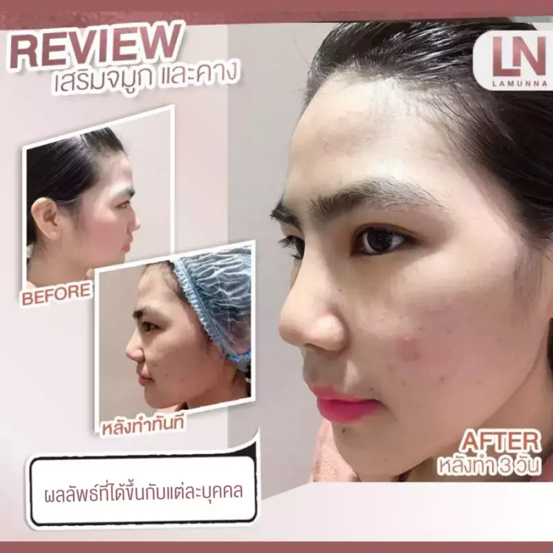 ภาพรีวิวเสริมจมูก ด้วยซิลิโคนแมนทิส ที่ Clinic Lamunna