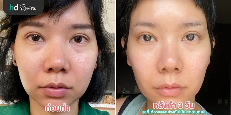 รีวิว ฝังเข็มกระตุ้นไฟฟ้า ลดริ้วรอยร่องแก้ม ที่ สวนกวางตุ้งคลินิก