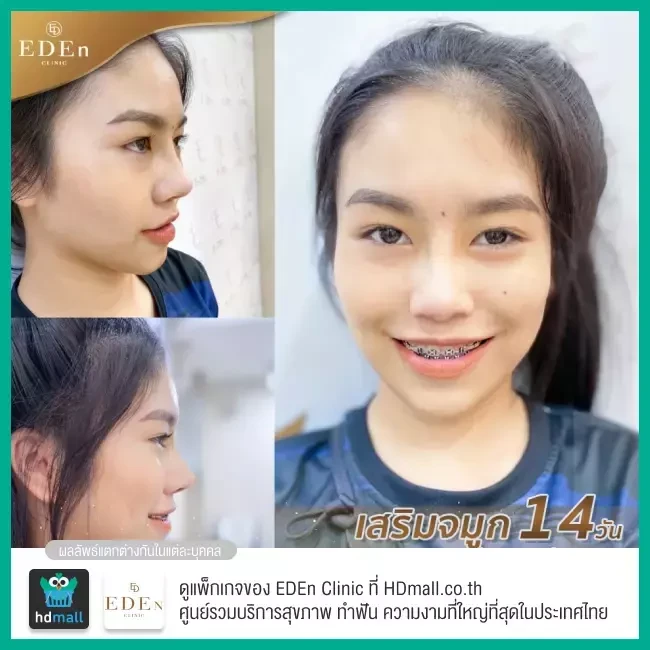 รีวิว เสริมจมูก ที่ E-Den Clinic
