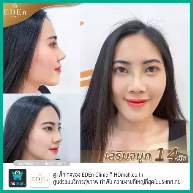 รีวิว เสริมจมูก ที่ E-Den Clinic