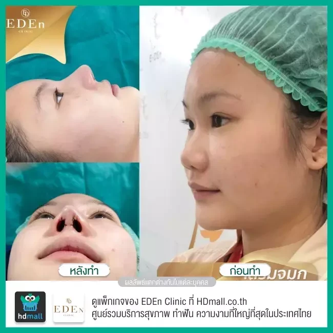 รีวิว เสริมจมูก ที่ E-Den Clinic
