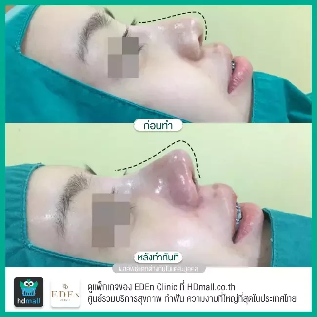 รีวิว เสริมจมูก ที่ E-Den Clinic