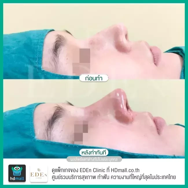 รีวิว เสริมจมูก ที่ E-Den Clinic