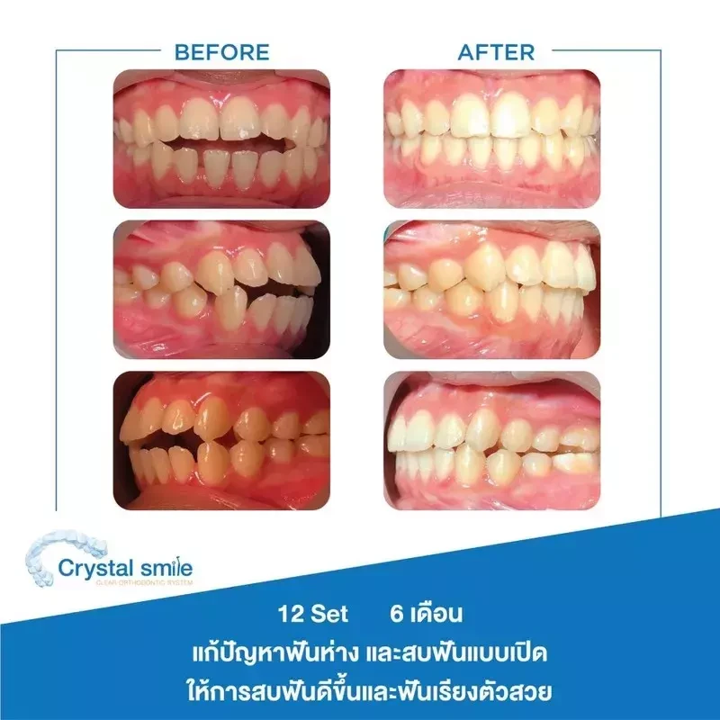 รวมรูปรีวิว จัดฟันใส Crystal Smile ที่ Bangkok Smile Dental