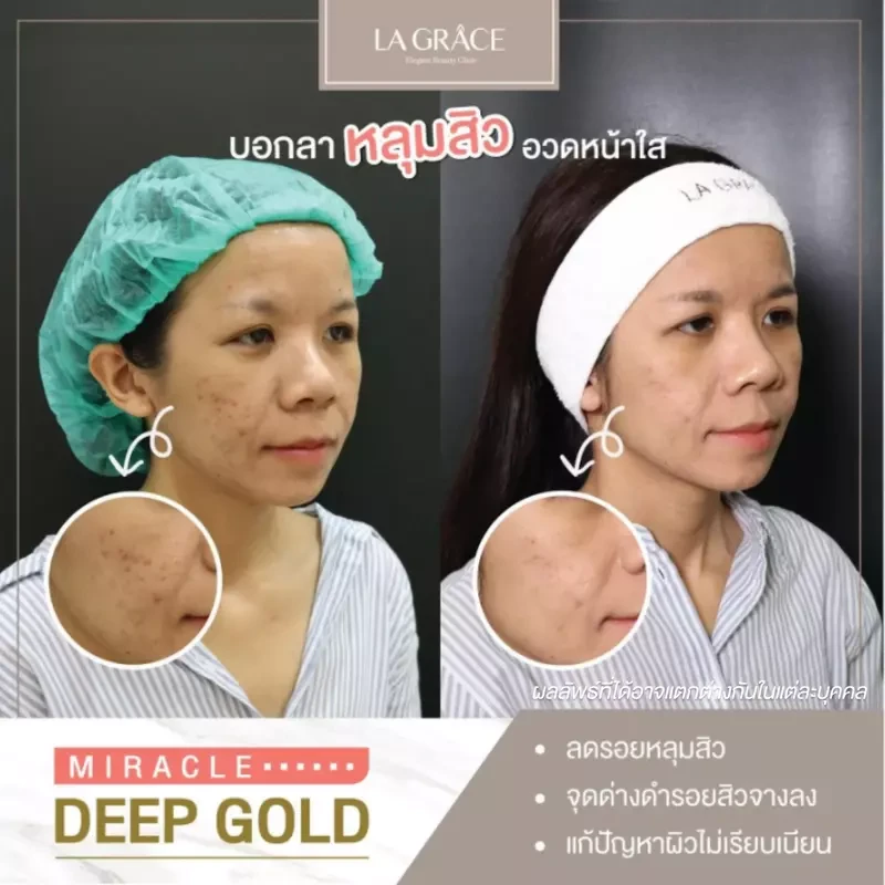 ภาพเปรียบเทียบ ก่อนและหลังรักษาหลุมสิวที่ La Grace Clinic