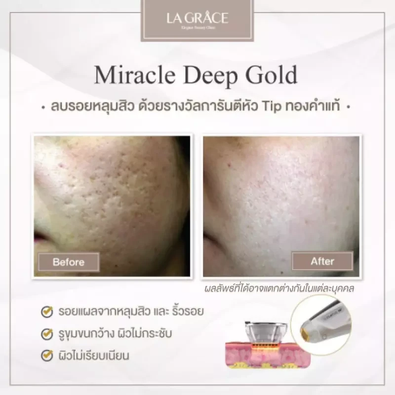 ภาพเปรียบเทียบ ก่อนและหลังรักษาหลุมสิวที่ La Grace Clinic