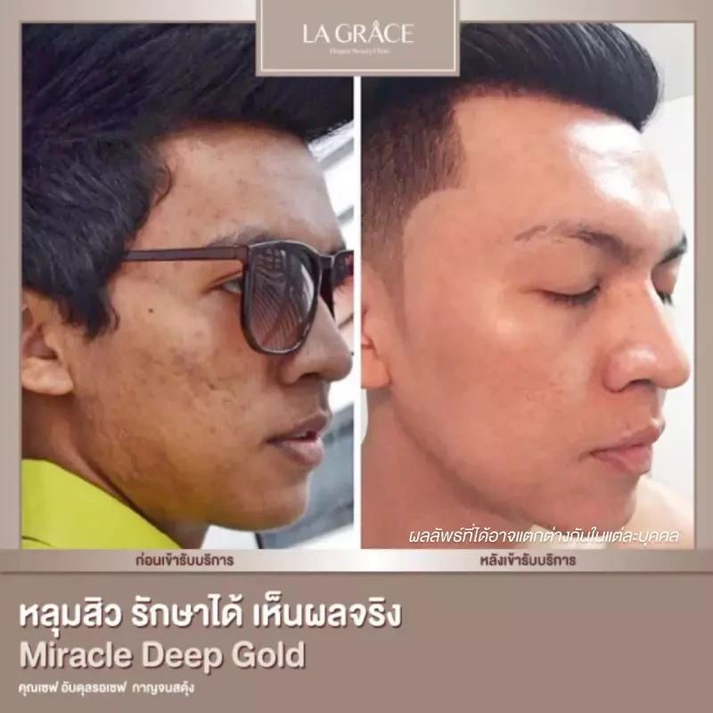 ภาพเปรียบเทียบ ก่อนและหลังรักษาหลุมสิวที่ La Grace Clinic