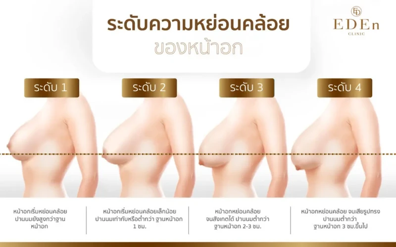 ระดับความหย่อนคล้อยของหน้าอก