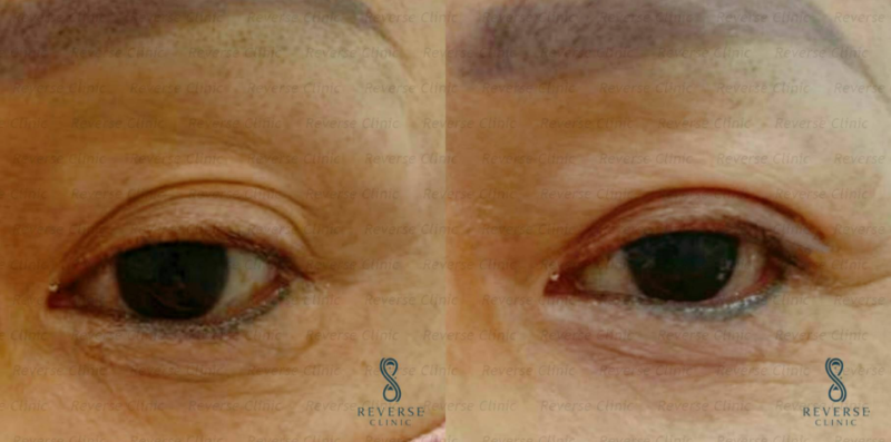 ใครเหมาะกับการทำ Celeb Eyes บ้าง?