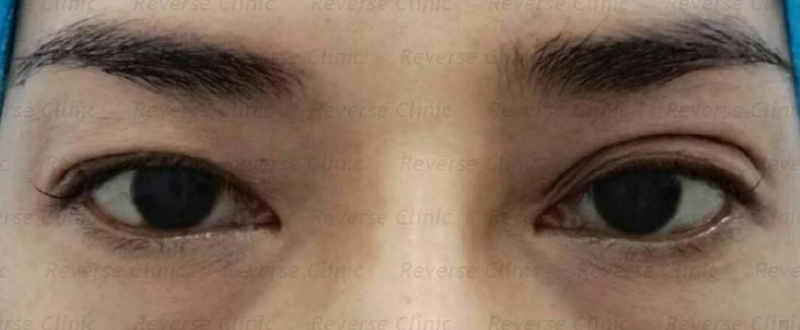 ใครเหมาะกับการทำ Celeb Eyes บ้าง?