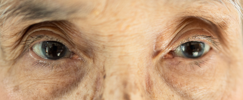 ใครไม่เหมาะกับการทำ Celeb Eyes?