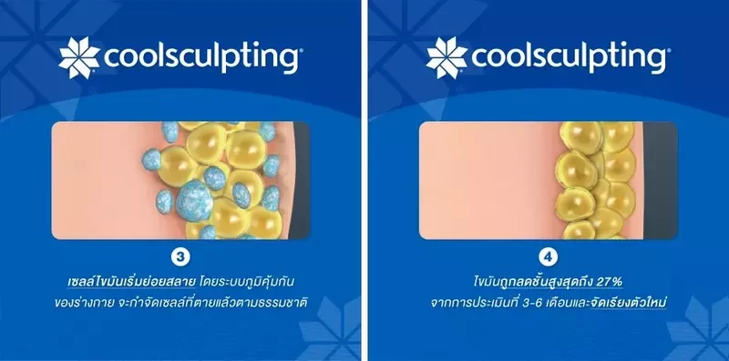 กระบวนการฆ่าเซลล์ไขมันผ่านการใช้เทคโนโลยี CoolSculpting