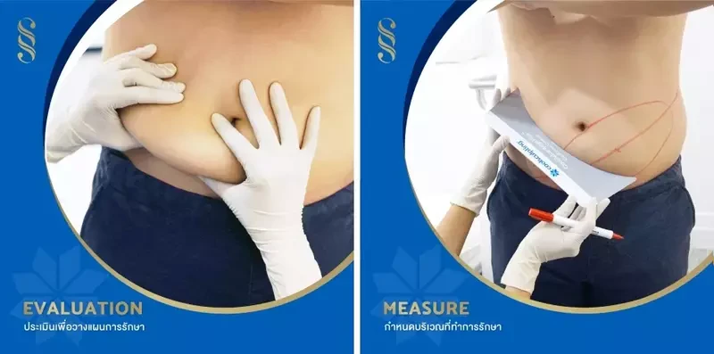 ขั้นตอนการรับบริการสลายไขมันด้วย CoolSculpting