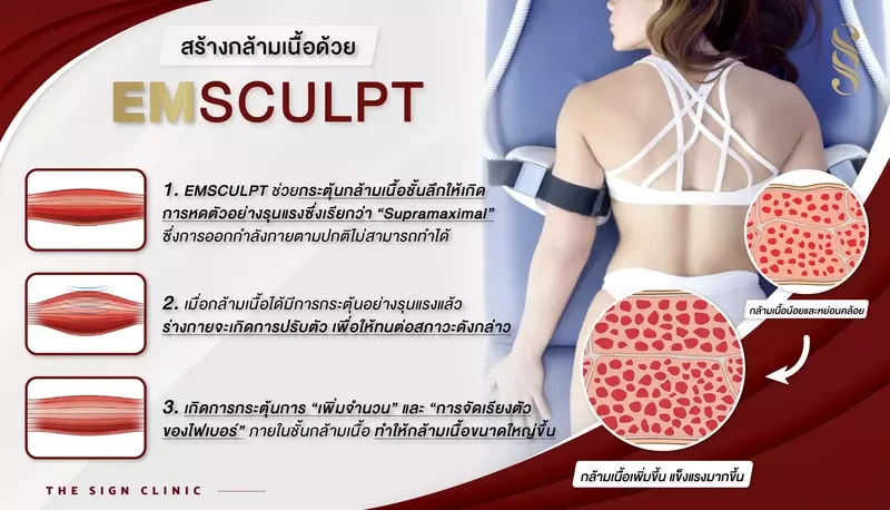 การสร้างกล้ามเนื้อด้วยเครื่อง Emsculpt