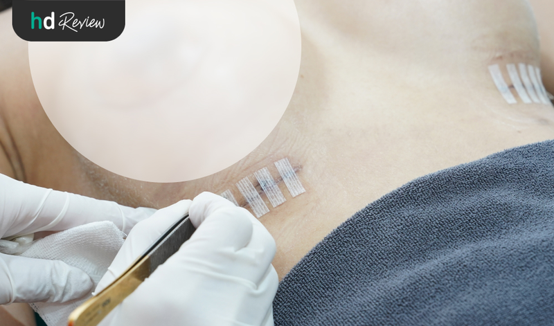 ตัดไหมหลังแก้หน้าอก ทำหน้าอกใหม่ ที่ Vincent Clinic