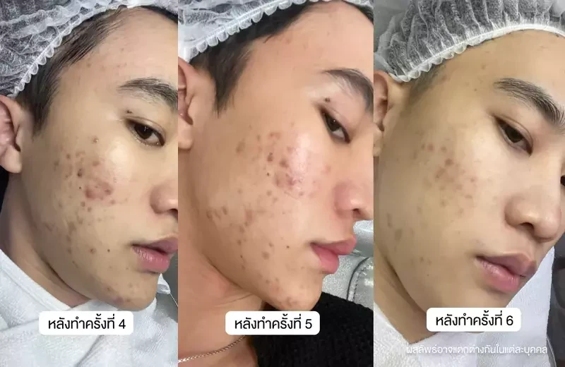 ผลลัพธ์หลังใช้บริการ 6 ครั้ง
