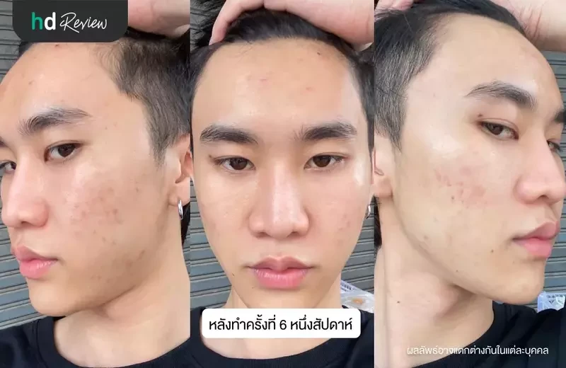 ผลลัพธ์หลังทำครั้งที่ 6 หนึ่งสัปดาห์