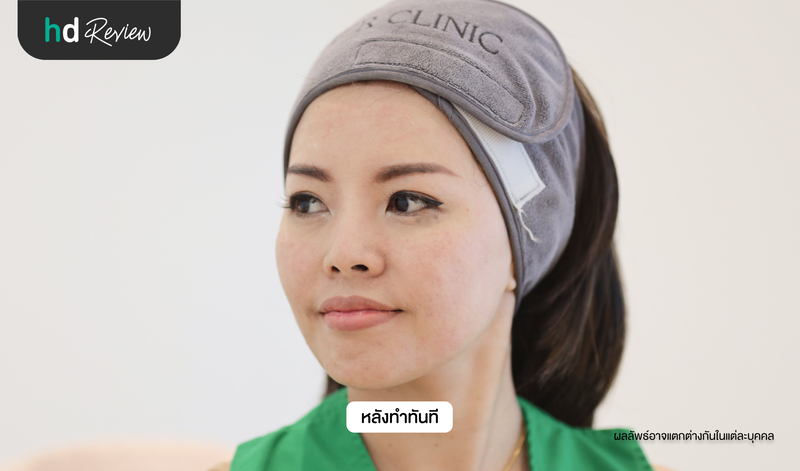 รีวิวโปรแกรมรักษาหลุมสิว Vinus Viva ที่ Cher Clinic
