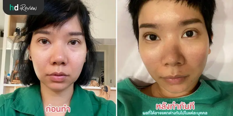 รีวิว ฝังเข็มกระตุ้นไฟฟ้า ลดริ้วรอยร่องแก้ม ที่ สวนกวางตุ้งคลินิก