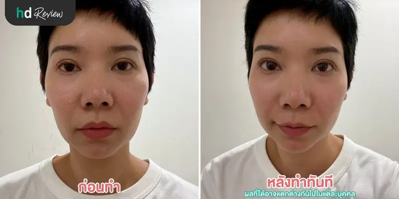 รีวิว ฝังเข็มกระตุ้นไฟฟ้า ลดริ้วรอยร่องแก้ม ที่ สวนกวางตุ้งคลินิก