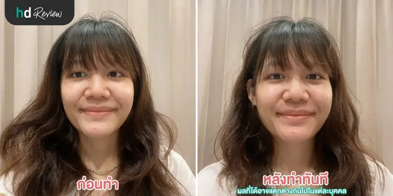 รีวิว ฝังเข็มลดริ้วรอยร่องแก้ม กระตุ้นไฟฟ้า ที่ สวนกวางตุ้งคลินิก