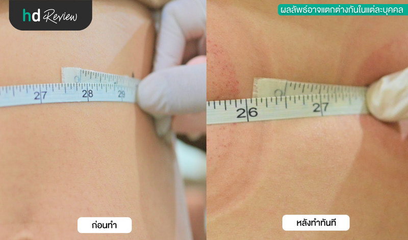 เปรียบเทียบก่อนและหลังฝังเข็ม ครอบแก้ว กระชับสัดส่วน ที่ Zhen Fu Clinic (​​เจินฟู่คลินิก)