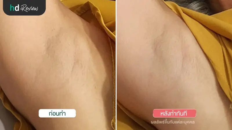 รีวิว IPL กำจัดขนรักแร้ ที่ Zenzen Clinic