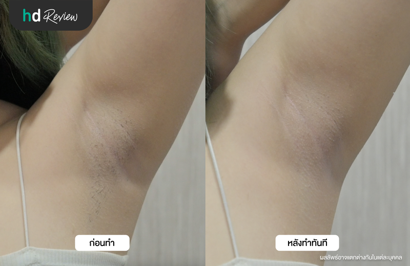 ผลลัพธ์หลังกำจัดขนรักแร้ ด้วย Diode Laser ทันที