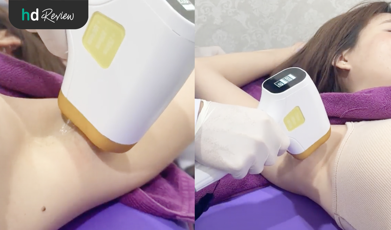 ขั้นตอนกำจัดขนรักแร้ ด้วย Diode Laser