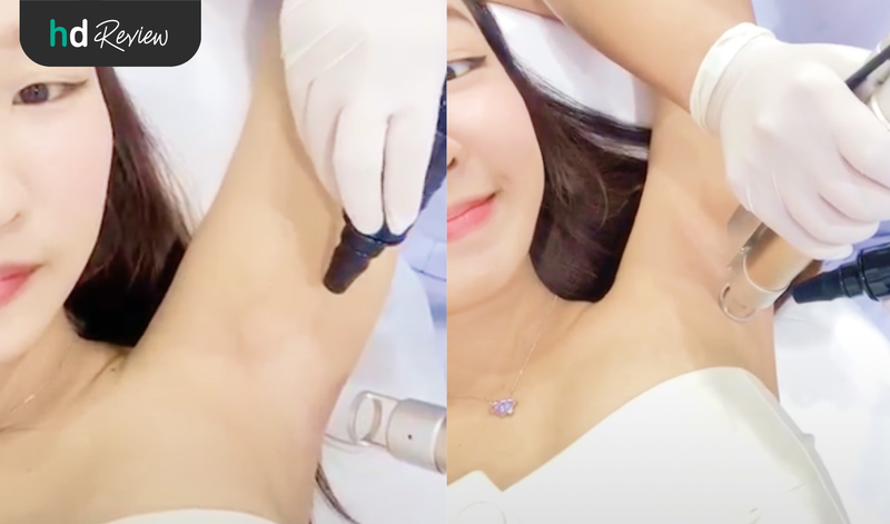 ขั้นตอนการทำเลเซอร์กำจัดขนรักแร้ โปรแกรม WOW AI LASER