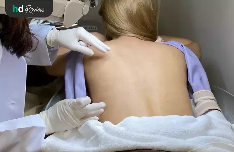 ขั้นตอนการรักษาสิวหลัง โปรแกรม Back Clear I ที่ Romrawin Clinic